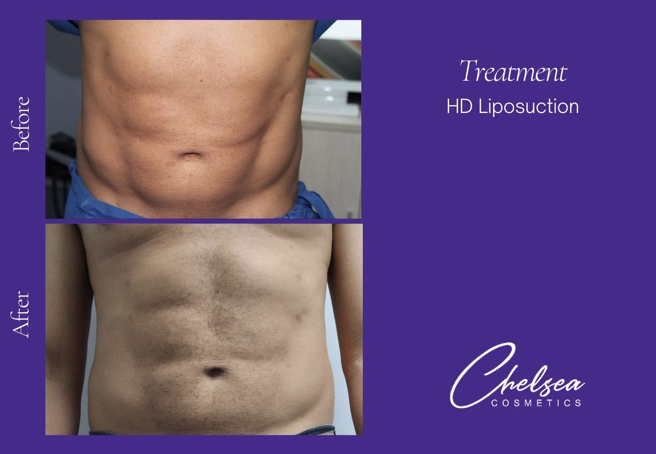 male high definition liposuction