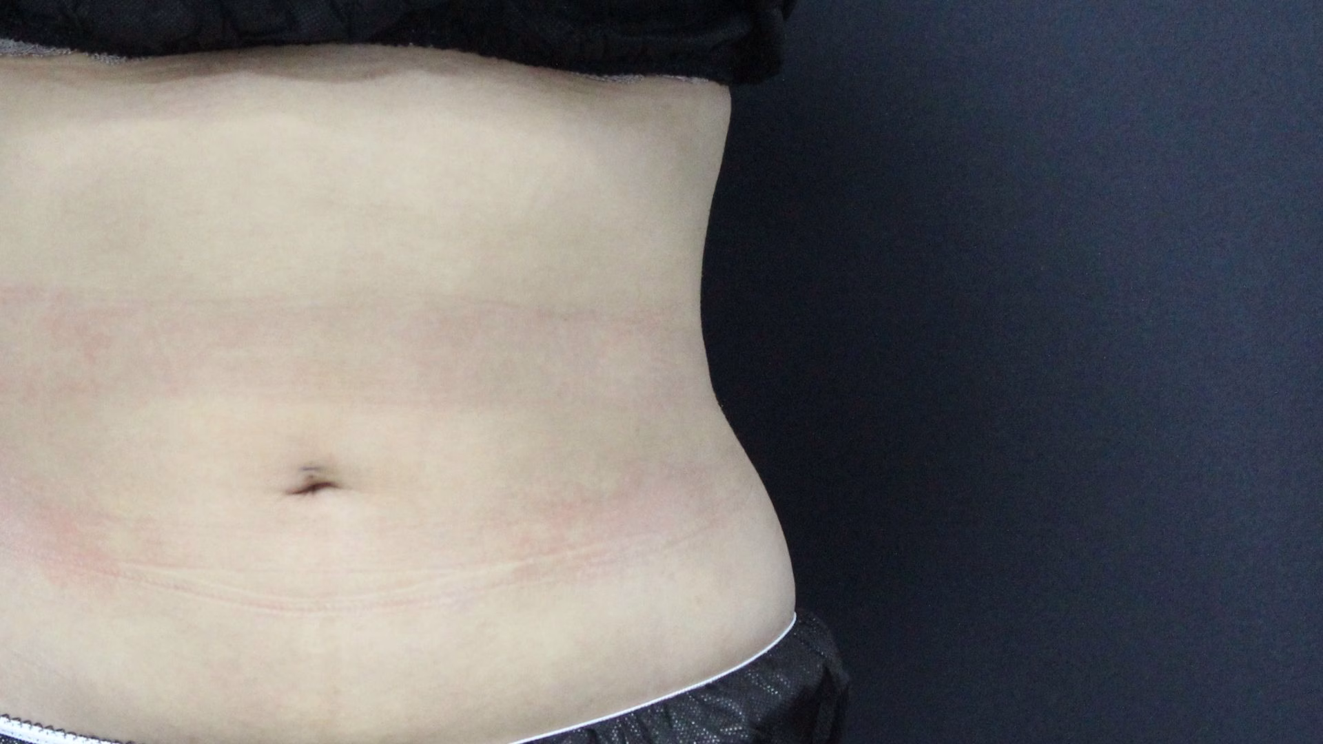 high definition liposuction before