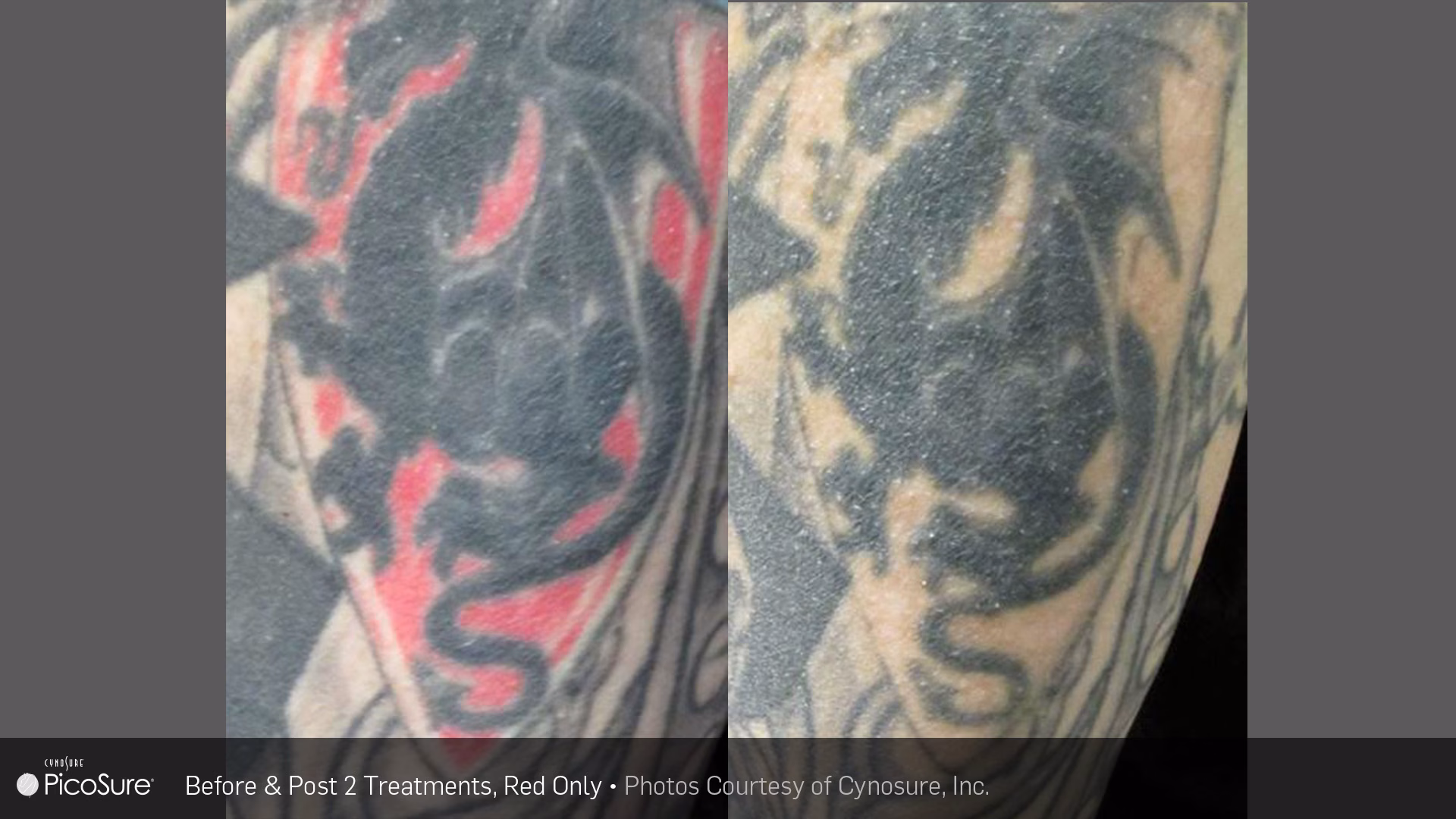 male high definition liposuction