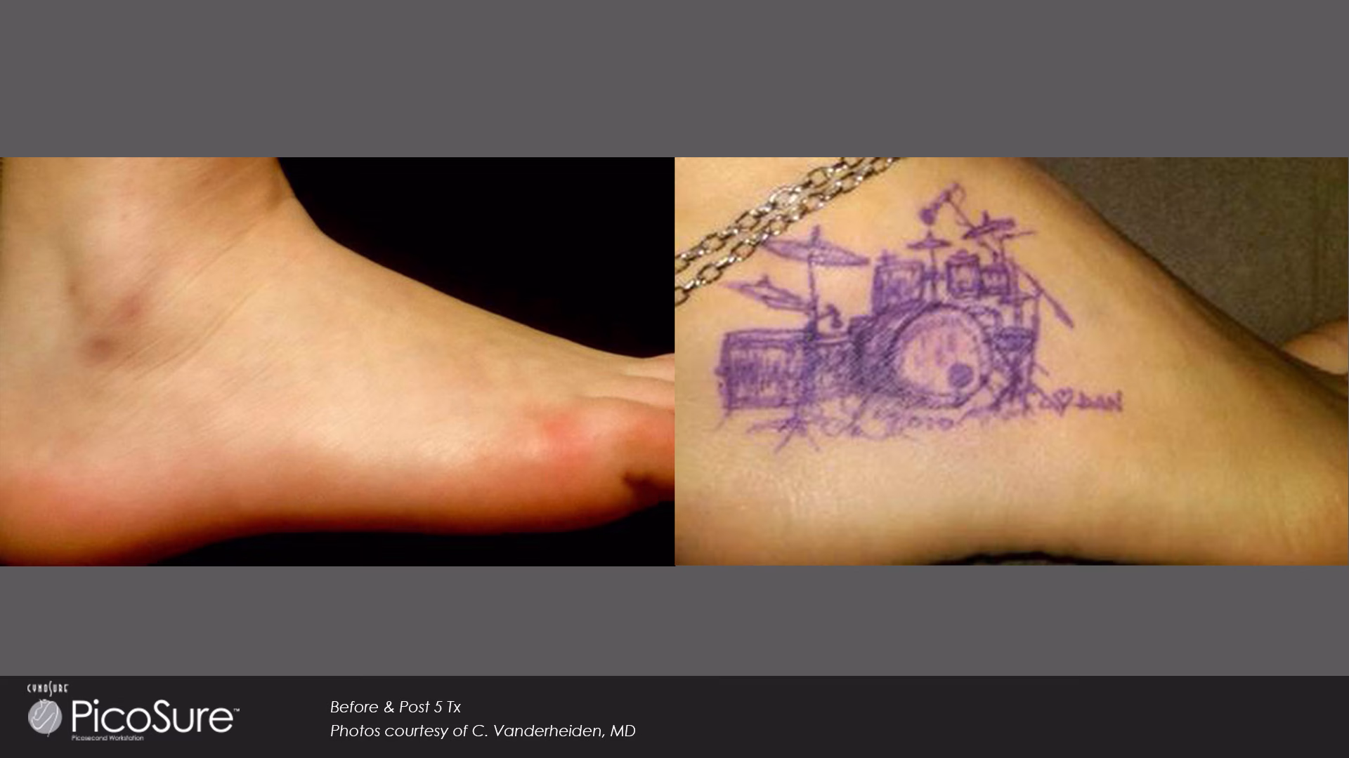 male high definition liposuction