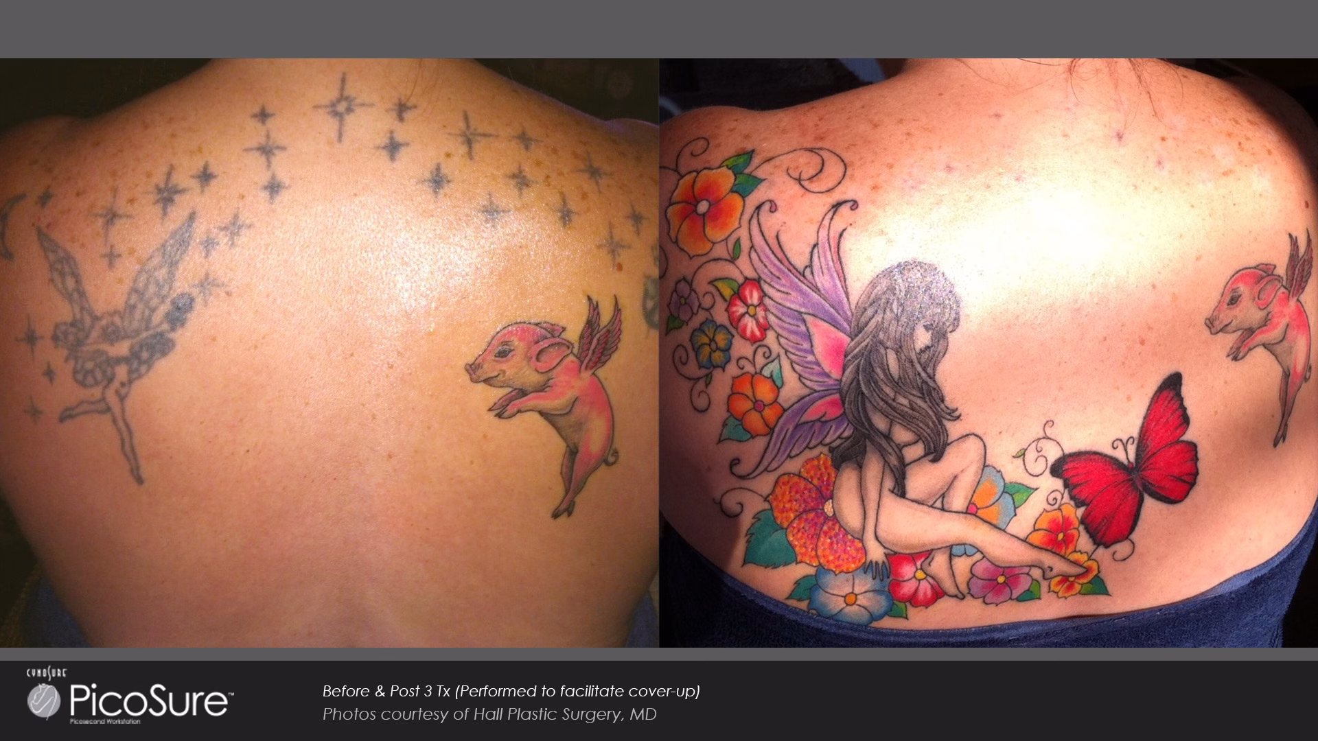 male high definition liposuction