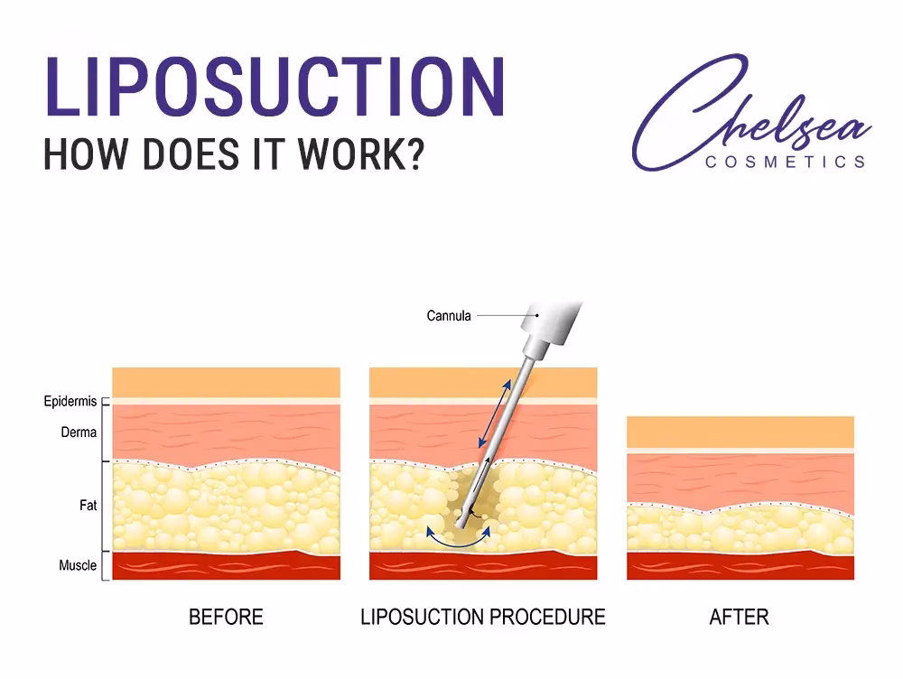 liposuction melbourne